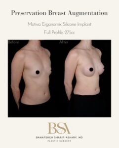 Breast Augmentation Before and After with Dr. Banafsheh Sharif-Askary in La Jolla & San Diego
